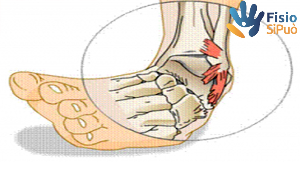 fisioterapia Roma Casalotti distorsione caviglia